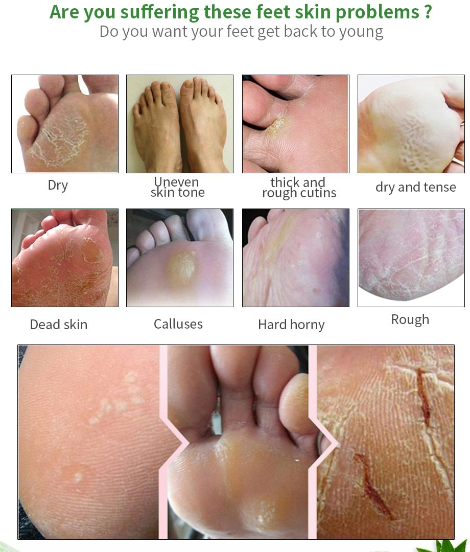 Foot peel mask